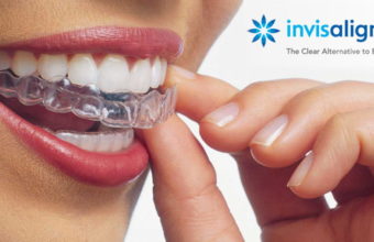 invisalign-1024x576